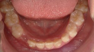 宇治市　歯医者　6843_mn_Oral lower_20240909　なかむら歯科医院