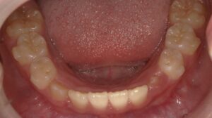 宇治市　歯医者　6843_mn_Oral lower_20250106　なかむら歯科医院