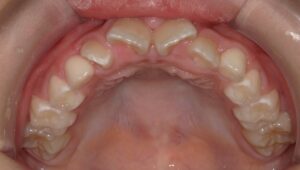 宇治市　歯医者　6843_mn_Oral upper_20240321　なかむら歯科医院