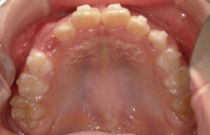 宇治市　歯医者　6843_mn_Oral upper_20240909　なかむら歯科医院