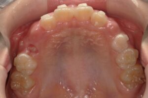 宇治市　歯医者　6843_mn_Oral upper_20250106　なかむら歯科医院