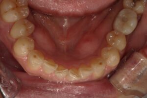 宇治市　歯医者　0126_yy_Oral lower_20240119　なかむら歯科医院