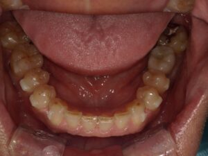 宇治市　歯医者　0126_yy_Oral lower_20240731　なかむら歯科医院