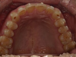 宇治市　歯医者　0126_yy_Oral upper_20240731　なかむら歯科医院