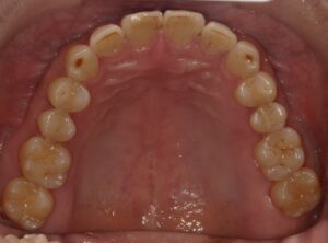 宇治市　歯医者　0126_yy_Oral upper_20241105　なかむら歯科医院
