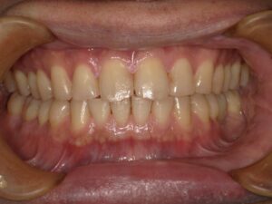 宇治市　歯医者　0126_yy_Whitening_20241125　なかむら歯科医院