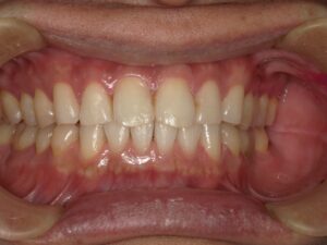 宇治市　歯医者　0126_yy_Whitening_20250127　なかむら歯科医院