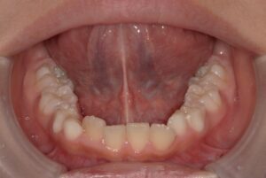 宇治市　歯医者　6854_hm_Oral lower_20240413　なかむら歯科医院
