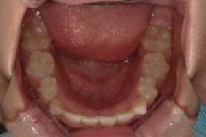 宇治市　歯医者　6854_hm_Oral lower_20240807　なかむら歯科医院
