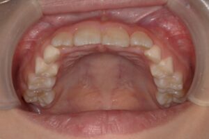 宇治市　歯医者　6854_hm_Oral upper_20240413　なかむら歯科医院