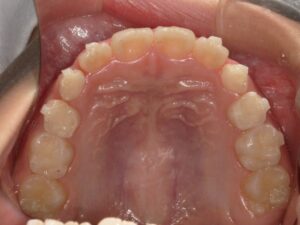 宇治市　歯医者　6854_hm_Oral upper_20241026　なかむら歯科医院