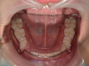 宇治市　歯医者　6854_hm_Retainer Lower_20250125　なかむら歯科医院