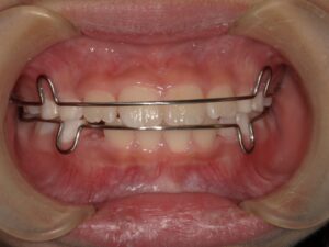 宇治市　歯医者　6854_hm_Retainer front_20250125　なかむら歯科医院