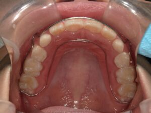 宇治市　歯医者　6854_hm_Retainer upper_20250125　なかむら歯科医院