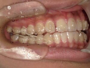 宇治市　歯医者　ortho rubber　なかむら歯科医院