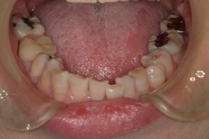 宇治市 歯医者 0007_kt_Oral lower_20230509 なかむら歯科医院