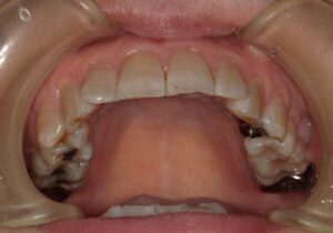 宇治市 歯医者 0007_kt_Oral upper_20230509 なかむら歯科医院