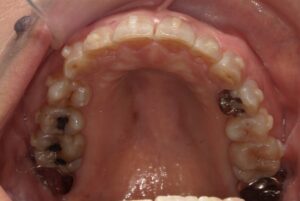 宇治市 歯医者 0007_kt_Oral upper_20250303 なかむら歯科医院