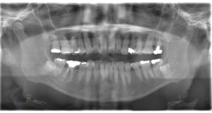 宇治市 歯医者 0007_kt_Panorama_20230509 なかむら歯科医院