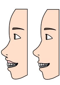 宇治市 歯医者 gummy smile 2 なかむら歯科医院