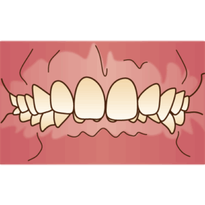 宇治市 歯医者 deep bite なかむら歯科医院