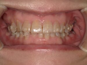 宇治市 歯医者 0007_KT_Oral front_20240109 なかむら歯科医院