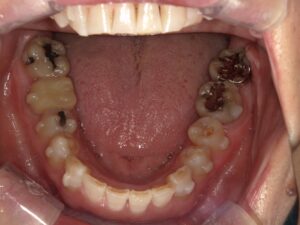 宇治市 歯医者 0007_KT_Oral lower_20241206 なかむら歯科医院