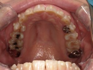 宇治市 歯医者 0007_KT_Oral upper_20241206 なかむら歯科医院