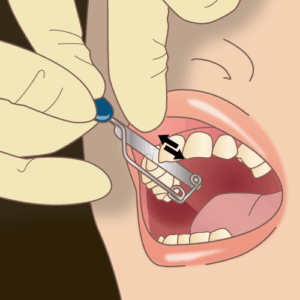 宇治市 歯医者 stripping なかむら歯科医院