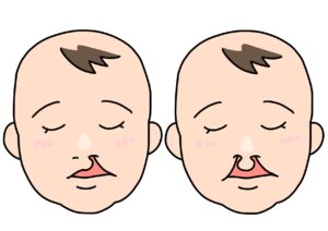 宇治市　歯医者　cleft lip　なかむら歯科医院